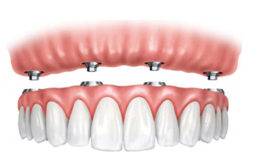 имплантация зубов схема
