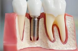 имплантация зубов вид сбоку