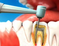 Зачем необходимо лечение каналов зуба и когда оно применяется