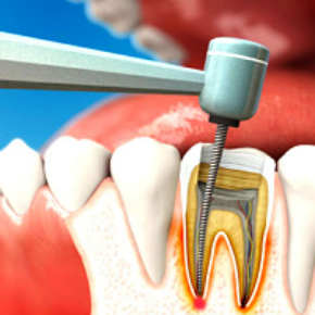 Зачем необходимо лечение каналов зуба и когда оно применяется